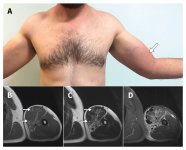 Myositis